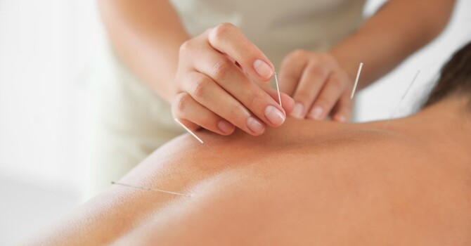 Acupuncture